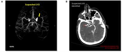 Head-to-head comparison of commercial artificial intelligence solutions for detection of large vessel occlusion at a comprehensive stroke center